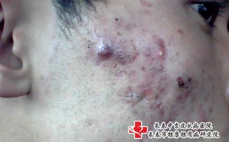 痤疮图片