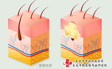 痤疮图片