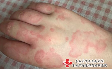 荨麻疹图片