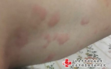 荨麻疹图片