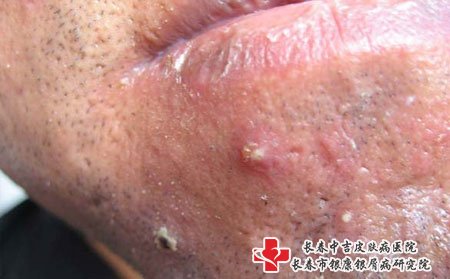 痤疮,痤疮调理,脸上痤疮护理