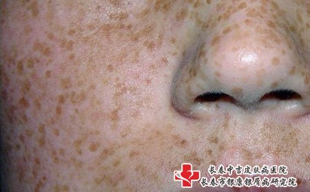 雀斑病因,男性会得雀斑吗