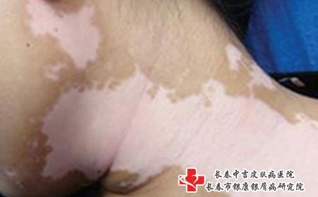 白癜风注意,冬季白癜风注意