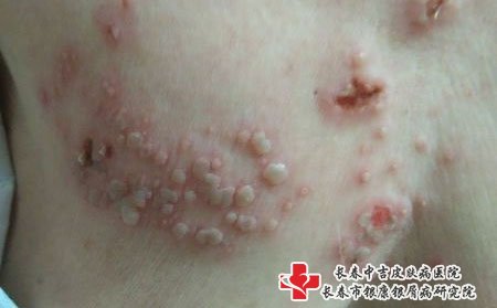带状疱疹,带状疱疹后遗症