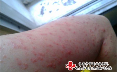 皮肤瘙痒,皮肤瘙痒是血液病吗