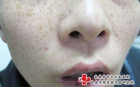 雀斑,怎样预防雀斑