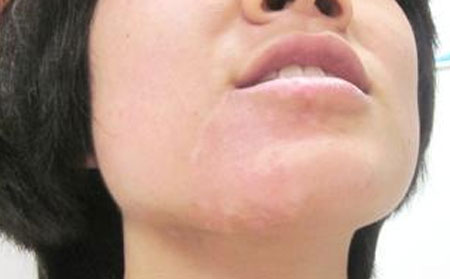 青少年白癜风患者喝水需要注意事项