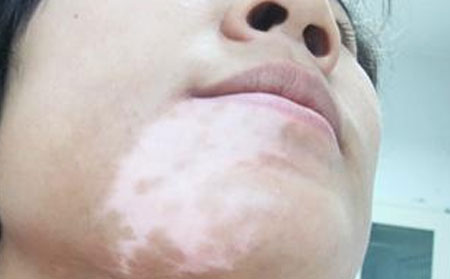 青少年得了白癜风应该注意什么