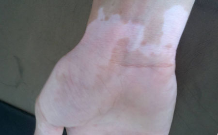 患白癜风后能不能要孩子？白癜风遗传吗？