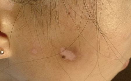 白癜风的常识问题有哪些需要知道？