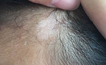 长春白癜风哪家医院治疗专业点