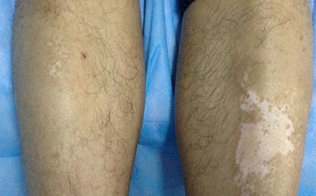 长春皮肤斌医院：脸上的白癜风怎么治疗恢复的快