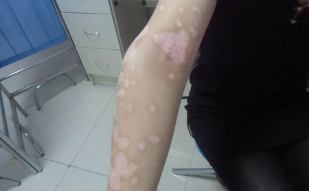 白癜风长在手部如何治疗呢？