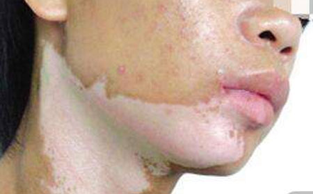 新疗法治白癜风效果如何
