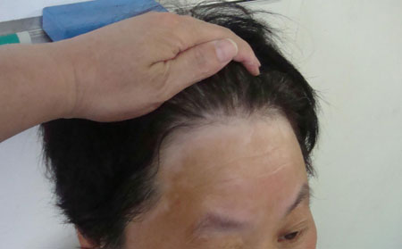 白癜风的日常护理要注意哪些呢?