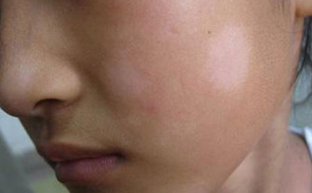 使用偏方治疗白癜风需要注意什么