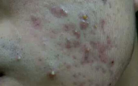 皮肤长痘的原因有哪些？