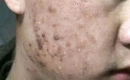 长春治青春痘费用需要多少