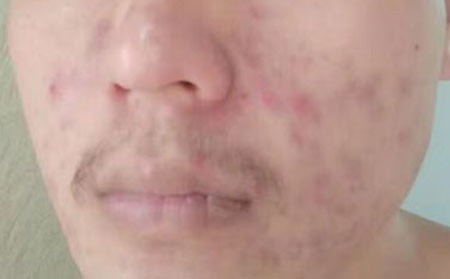 长春青春痘医院哪个好