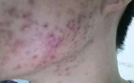 用手挤痘痘有什么危害？