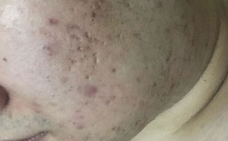 长春皮肤病医院挂号预约：痘痘化脓应该怎么办