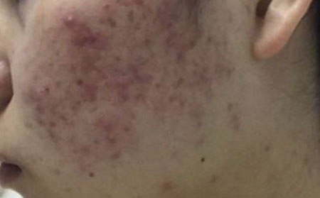 长春皮肤病研究所：青春痘怎么治疗比较好