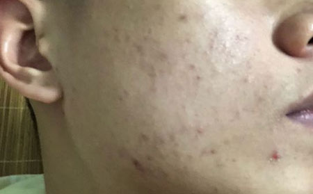 长春治痘痘好的医院