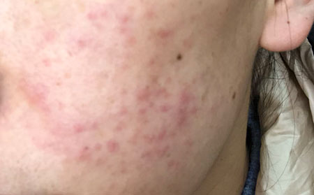 痤疮的调理方法有哪些呢？