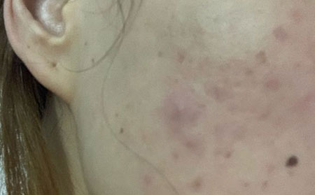 长春青春痘治疗哪个医院比较好