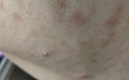 如何选择一家好的治疗青春痘医院
