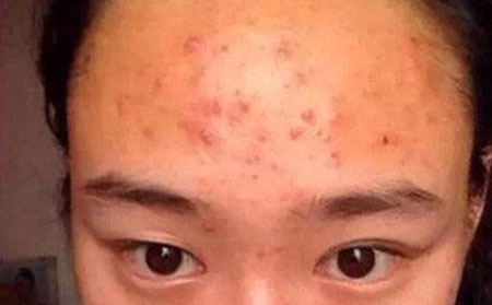 长春治痘痘哪个医院好