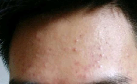 长春皮肤病研究所专家解说:脸上老长痘痘是什么原因