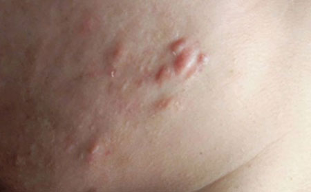 长春皮肤病研究所专家介绍：长痘痘的原因是什么