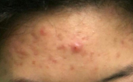 长春皮肤病研究所:青春痘有哪些症状