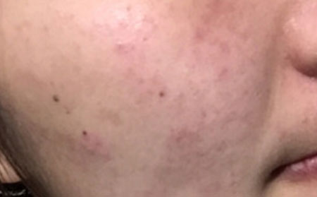 后背长痘是什么原因？