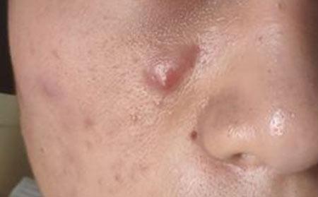 长春哪里治疗痤疮比较好