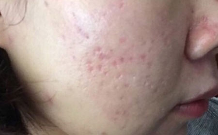 长春医院治疗痤疮--患有痤疮该怎么治疗好