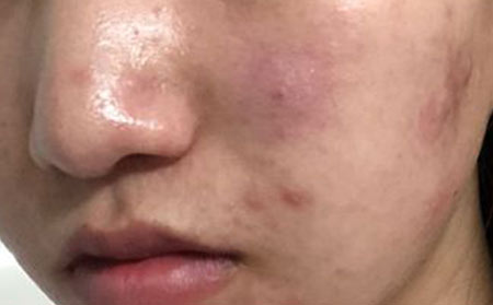 季节性出现爆痘该怎么控制