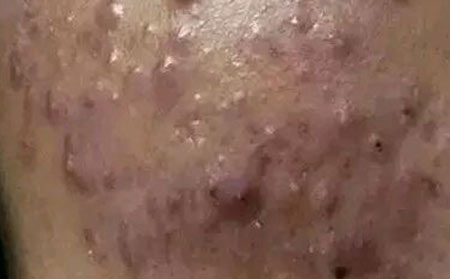 长春治疗痤疮--遗传是不是长痤疮的原因