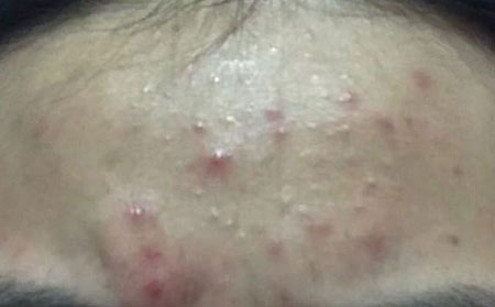 长春治疗痘痘比较好的医院