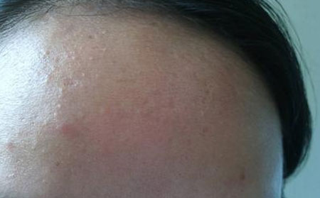 长春皮肤病医院:青春痘患者怎么做好预防