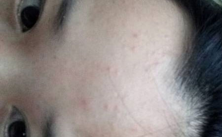 长春治青春痘哪个医院好