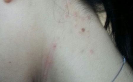 长春青春痘医院哪个较好