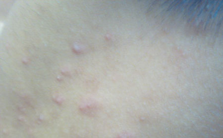长春治疗皮肤病医院：痤疮的症状通常有哪些