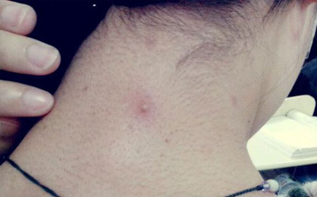 不同的痤疮类型都有什么症状?