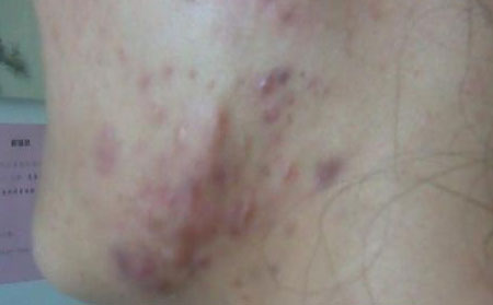 长春青春痘小知识