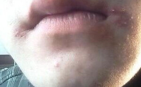 长春治疗青春痘的费用有多少