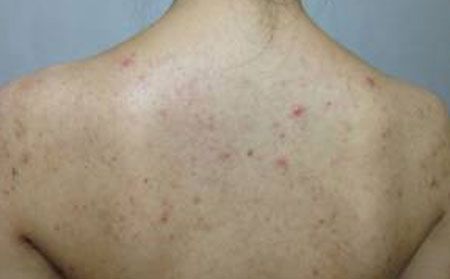长春皮肤病研究所：如何预防青春痘的发生