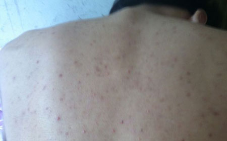 脸上患有痤疮症状是啥样的?
