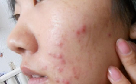 长春皮肤科研究所：痤疮发病原因都有哪些